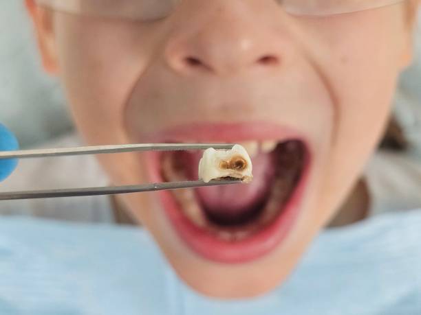 Best Emergency Dental Care for Trauma or Injury in Canton, MO