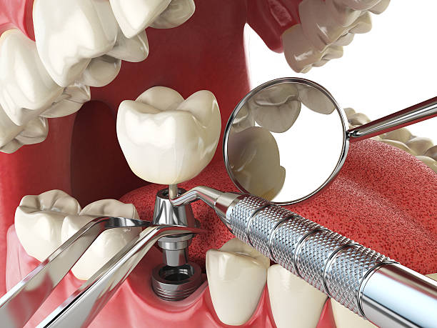 Best Emergency Broken Tooth Repair in Canton, MO